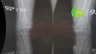 فیلم  واقعی درمان درد زانوهای پرانتزی در پیرمرد