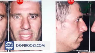 جراحی شکستگی و گرفتگی بینی