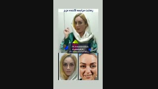 عمل بینی یک هفته بعد از جراحی!!!!!!!