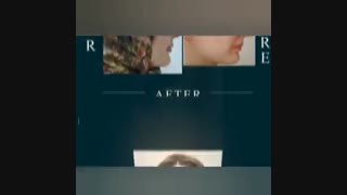 نمونه کار عمل بینی فانتزی 3 ماه بعد از جراحی