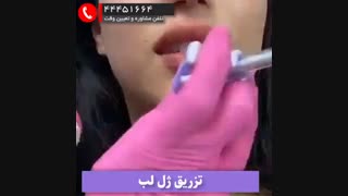 تزریق ژل روسی