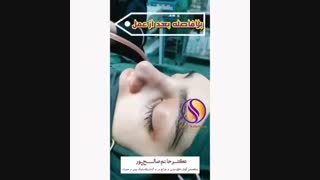 جراحی زیبایی بینی