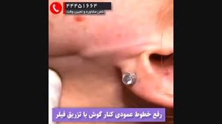 تزریق ژل روی خط کناری گوش