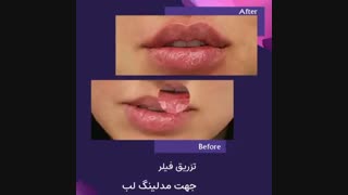 فیلم نتیجه تزریق فیلر لب