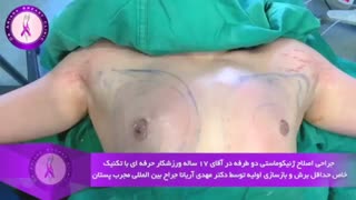 عمل ژنیکوماستی در آقای 17 ساله