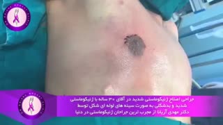 بزرگی شدید پستان ها در آقای 30 ساله