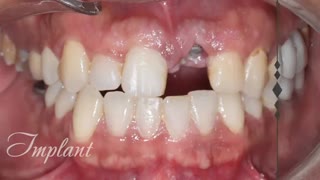 بازسازی کامل دهان | دکتر لیلا عطایی