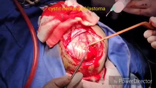 عمل اورژانسی تومور مغزی در بچه سه ساله