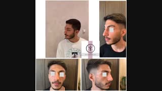 فیلم جراحی بینی مردانه