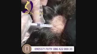 فیلم واقعی درمان ریزش مو با تزریق