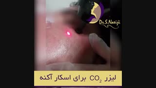 فیلم درمان جای زخم آکنه با لیزر بدون سانسور