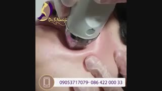 آر اف فرکشنال، یک راه حل موثر برای اسکار و آکنه، منافذ پوست و لیفت صورت لیفت پیشانی