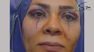 جراحی همزمان بلفاروپلاستی و پتوز چشم