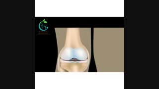 ترمیم شکستگی کشکک