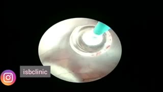 فیلم عمل جراحی نوروآندوسکوپی مغز در درمان هیدروسفالی