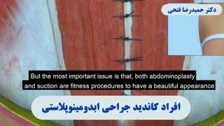 جراحی زیبایی شکم