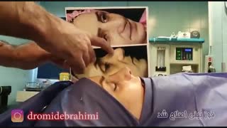 فیلم جراحی بینی گوشتی