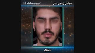 فیلم جراحی زیبایی بینی