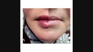 فیلم واقعی قبل و بعد از تزریق ژل لب