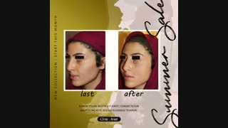 فیلر گونه زاویه سازی صورت