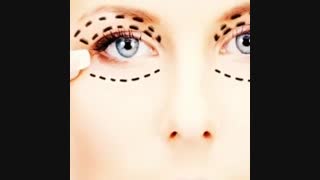 بلفاروپلاستی