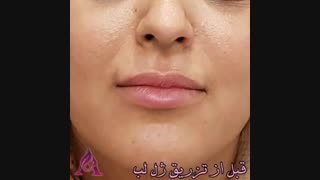 فیلم واقعی تزریق ژل لب