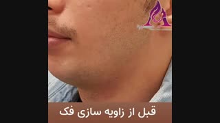 فیلم واقعی زاویه سازی فک با تزریق فیلر