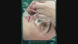 فیلم واقعی بلافاصله پس از برداشتن اسپلینت بینی