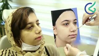 فیلم عمل بینی گوشتی دکتر علی بصام