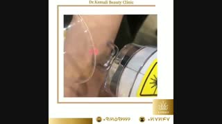 فیلم درمان جای زخم قدیمی با لیزر فرکشنال CO2