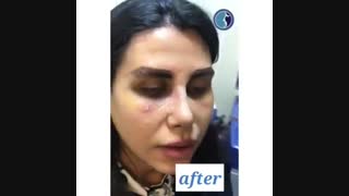 فیلم برداشتن گچ بینی بعد از عمل بینی و رضایت بیمار