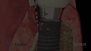 اشتباه در کاشت ایمپلنت