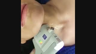 هایفوتراپی ترمیم لبخند لثه‌ای