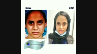 نمونه کار عمل بینی کج