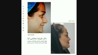 عمل بینی در سنین بالا به صورت فانتزی