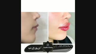 فیلم تزریق ژل لب و تزریق فیلر چانه لیفت پیشانی