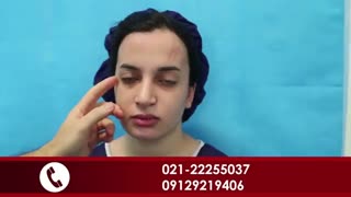 لیفت آندوسکوپی پیشانی و تزریق چربی و چال لپ