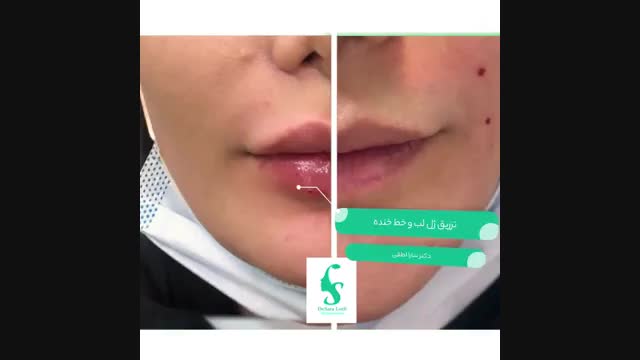 تزریق ژل لب و خط خنده برای مراجعه کننده عزیزمون نماشا