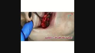 فیلم کامل ایمپلنت دندان فک بالا