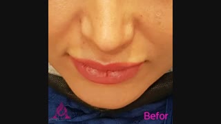 نمونه کار واقعی تزریق فیلر چانه