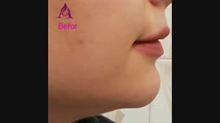 نمونه تزریق فیلر هیالورونیک اسید به چانه