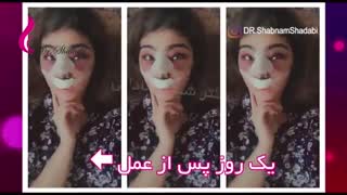 8 ماه بعد از عمل بینی