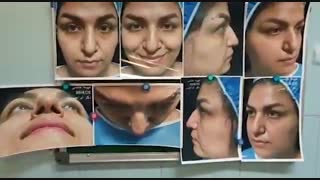 فیلم جراحی افتادگی بینی