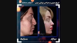 فیلم همزمان جراحی زیبایی بینی و تزریق چربی