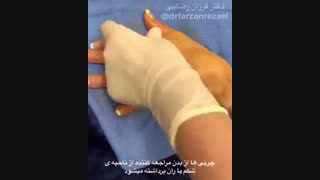 فیلم تزریق چربی به دست رفع افتادگی پلک