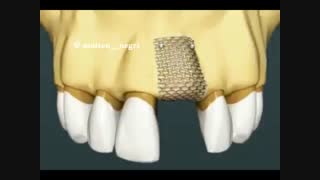بازسازی استخوان با کمک مش تیتانیومی