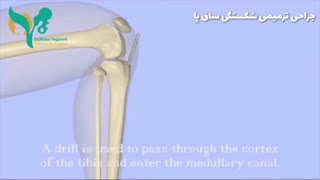 فیلم واقعی جراحى ترمیمى شکستگى ساق پا