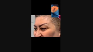 فیلم بلفاروپلاستی پلک بالا