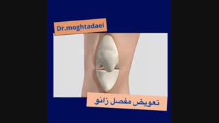 تعویض مفصل زانو از نمایی دیگر