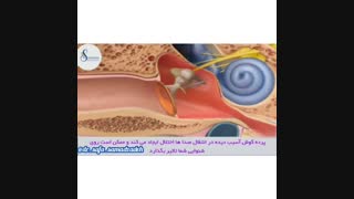 آسیب های مرتبط با پرده گوش